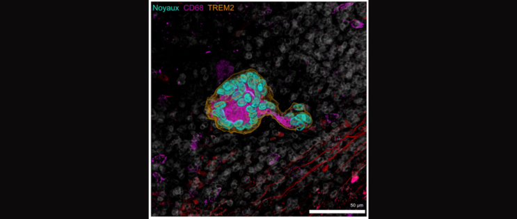 Découverte d'un nouveau biomarqueur pronostique dans les carcinomes épidermoïdes ORL